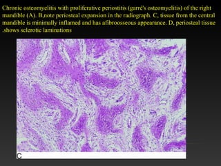 Chronic osteomyelitis with proliferative periostitis (garré's osteomyelitis) of the right
mandible (A). B,note periosteal expansion in the radiograph. C, tissue from the central
mandible is minimally inflamed and has afibroosseous appearance. D, periosteal tissue
shows sclerotic laminations.
 