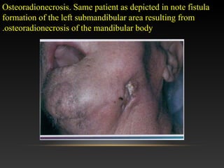 Osteoradionecrosis. Same patient as depicted in note fistula
formation of the left submandibular area resulting from
osteoradionecrosis of the mandibular body.
 