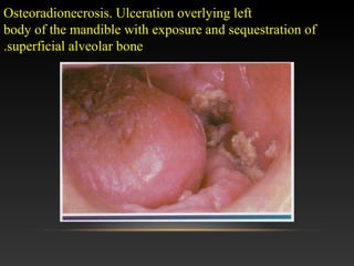 Osteoradionecrosis. Ulceration overlying left
body of the mandible with exposure and sequestration of
superficial alveolar bone.
 