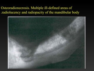 Osteoradionecrosis. Multiple ill-defined areas of
radiolucency and radiopacity of the mandibular body.
 