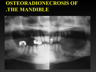 OSTEORADIONECROSIS OF
THE MANDIBLE.
 