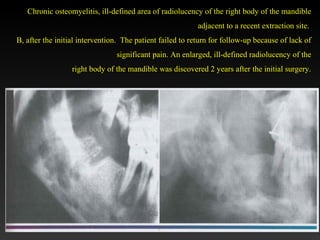 Chronic osteomyelitis, ill-defined area of radiolucency of the right body of the mandible
adjacent to a recent extraction site.
B, after the initial intervention. The patient failed to return for follow-up because of lack of
significant pain. An enlarged, ill-defined radiolucency of the
right body of the mandible was discovered 2 years after the initial surgery.
 