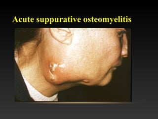 Acute suppurative osteomyelitis
 