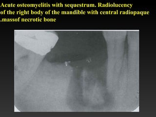 Acute osteomyelitis with sequestrum. Radiolucency
of the right body of the mandible with central radiopaque
massof necrotic bone.
 
