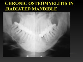 CHRONIC OSTEOMYELITIS IN
RADIATED MANDIBLE.
 