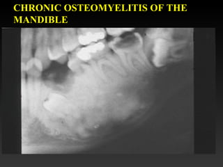 CHRONIC OSTEOMYELITIS OF THE
MANDIBLE
 