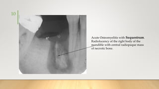 10
Acute Osteomyelitis with Sequestrum.
Radiolucency of the right body of the
mandible with central radiopaque mass
of necrotic bone.
 