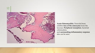 12
Acute Osteomyelitis. Nonvital bone
exhibits loss of the osteocytes from the
lacunae. Peripheral resorption, bacterial
colonization,
and surrounding inflammatory response
also can be seen.
 