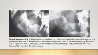 Chronic Osteomyelitis. A, Ill-defined area of radiolucency of the right body of the mandible adjacent to a
recent extraction site. B, After the initial intervention, the patient failed to return for follow-up because of
lack of significant pain. An enlarged, ill-defined radiolucency of the right body of the mandible was
discovered 2 years after the initial surgery.
 