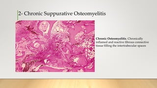 2- Chronic Suppurative Osteomyelitis
Chronic Osteomyelitis. Chronically
inflamed and reactive fibrous connective
tissue filling the intertrabecular spaces
 