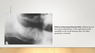 Diffuse Sclerosing Osteomyelitis. Diffuse area of
increased radiodensity of the right body of the
mandible in the tooth bearing area. No other
quadrants involved.
 
