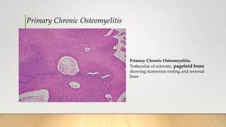 Primary Chronic Osteomyelitis
Primary Chronic Osteomyelitis.
Trabeculae of sclerotic, pagetoid bone
showing numerous resting and reversal
lines
 