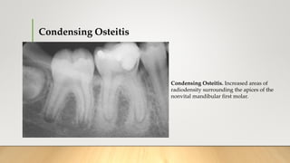 Condensing Osteitis
Condensing Osteitis. Increased areas of
radiodensity surrounding the apices of the
nonvital mandibular first molar.
 