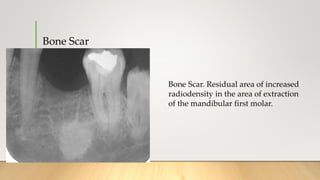 Bone Scar
Bone Scar. Residual area of increased
radiodensity in the area of extraction
of the mandibular first molar.
 