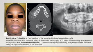 Proliferative Periostitis. A, Firm swelling of the lateral and inferior border of the right
mandible that arose after traumatic injury. B, Computed tomography (CT) image demonstrating new periosteal
bone growth with onionskin laminations. C, Panoramic radiograph exhibiting new periosteal bone formation
along the right inferior border of the mandible.
 