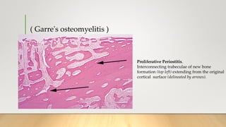 ( Garre's osteomyelitis )
Proliferative Periostitis.
Interconnecting trabeculae of new bone
formation (top left) extending from the original
cortical surface (delineated by arrows).
 