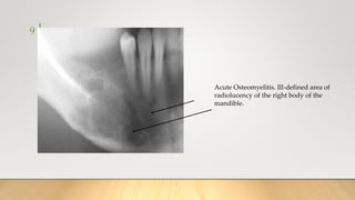 9
Acute Osteomyelitis. Ill-defined area of
radiolucency of the right body of the
mandible.
 