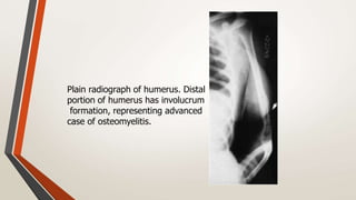 Bone infections...5 th stage lecture(dr.farouk) | PPTX