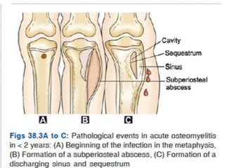 BONE INFECTIONS.pptx