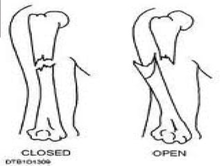 Bone injuries | PDF