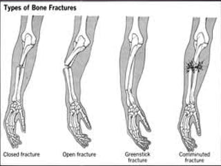 Bone injuries | PDF
