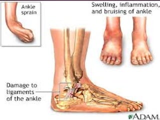 Bone injuries | PDF