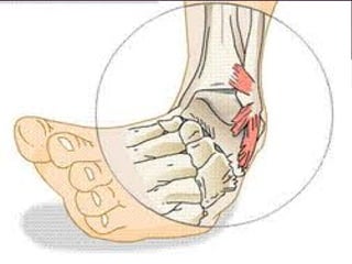 Bone injuries | PDF