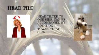 HEAD TILT
HEAD TILTED TO
ONE SIDE; CAN BE
ACCOMPANIED BY
ROTATION
TOWARD THAT
SIDE
 