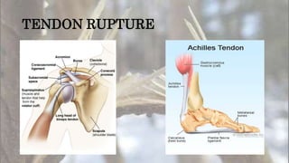 TENDON RUPTURE
 