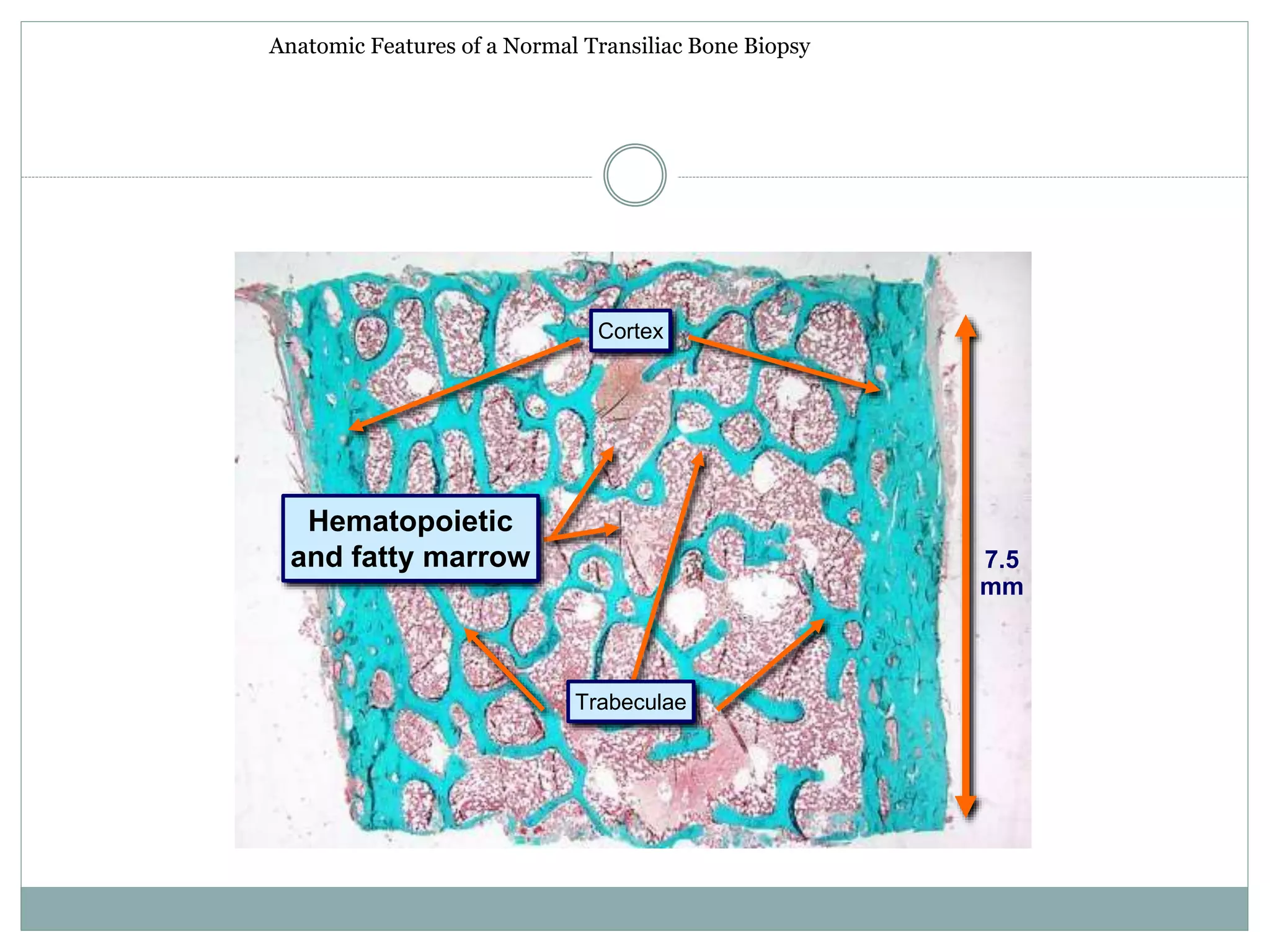 Anatomic Features of a Normal Transiliac Bone Biopsy
7.5
mm
Cortex
Trabeculae
Hematopoietic
and fatty marrow
 