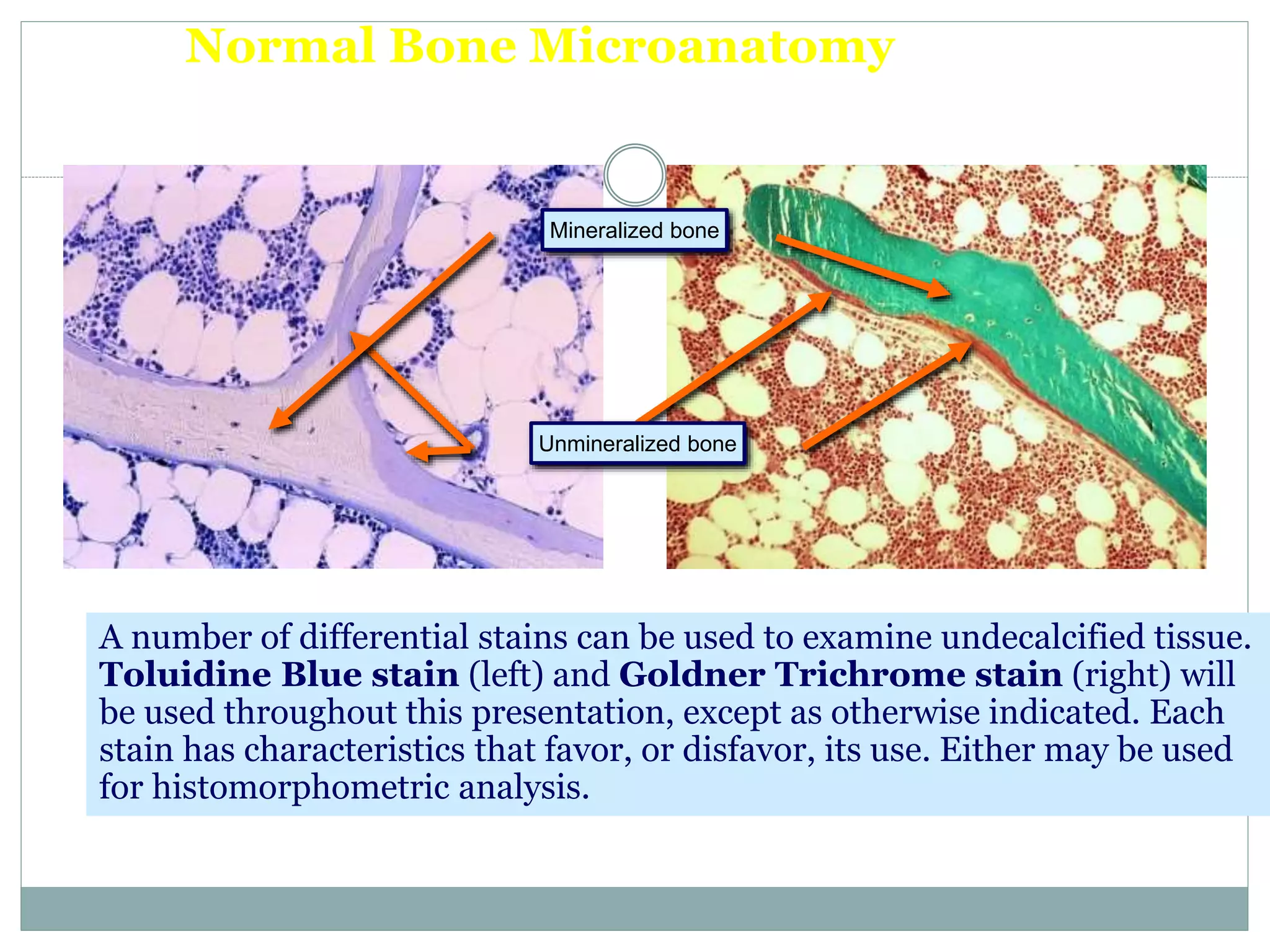 Normal Bone Microanatomy
Differential Tissue Stains
A number of differential stains can be used to examine undecalcified tissue.
Toluidine Blue stain (left) and Goldner Trichrome stain (right) will
be used throughout this presentation, except as otherwise indicated. Each
stain has characteristics that favor, or disfavor, its use. Either may be used
for histomorphometric analysis.
Unmineralized bone
Mineralized bone
 