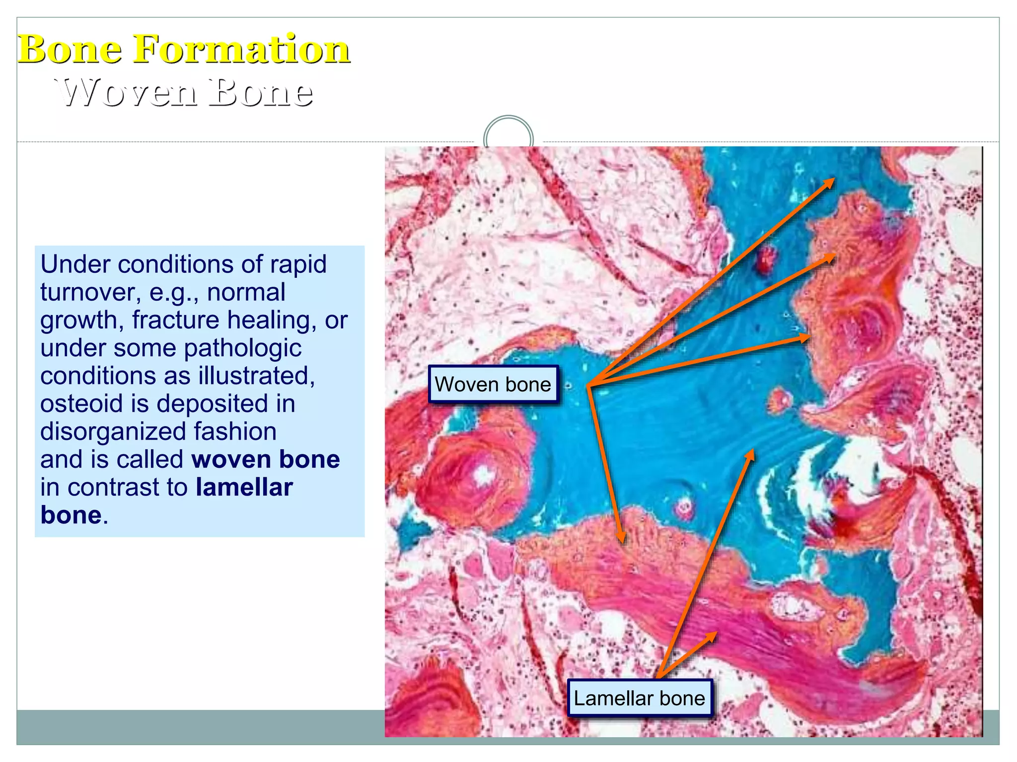 Bone Formation
Woven Bone
Under conditions of rapid
turnover, e.g., normal
growth, fracture healing, or
under some pathologic
conditions as illustrated,
osteoid is deposited in
disorganized fashion
and is called woven bone
in contrast to lamellar
bone.
Lamellar bone
Woven bone
 