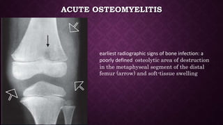 Bone, joint and spinal infection | PPTX