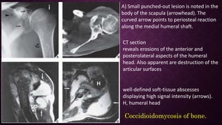 Bone, joint and spinal infection | PPTX