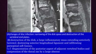 Bone, joint and spinal infection | PPTX