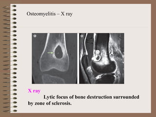 Osteomyelitis – X ray
X ray
Lytic focus of bone destruction surrounded
by zone of sclerosis.
 