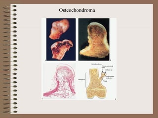 Osteochondroma
 