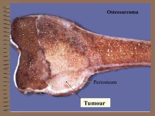 Tumour
Periosteum
Osteosarcoma
 
