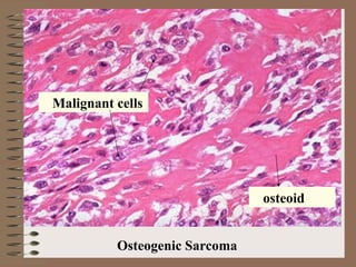 Osteogenic Sarcoma
osteoid
Malignant cells
 