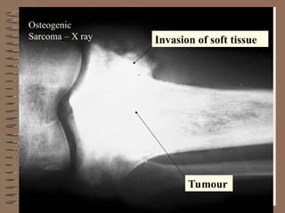 Tumour
Invasion of soft tissue
Osteogenic
Sarcoma – X ray
 