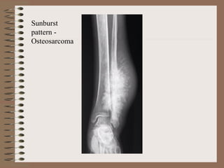 Sunburst
pattern -
Osteosarcoma
 