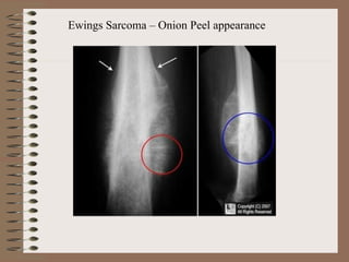 Ewings Sarcoma – Onion Peel appearance
 
