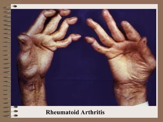Rheumatoid Arthritis
 