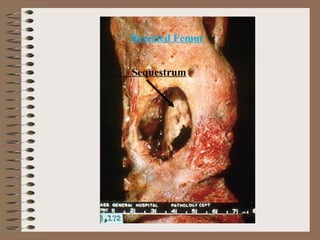 Sequestrum
Resected Femur
 