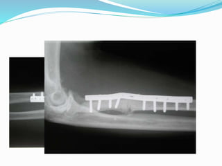 Bone Pressed Approach Bone lesion approach | PPTX