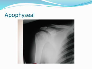Bone Pressed Approach Bone lesion approach | PPTX