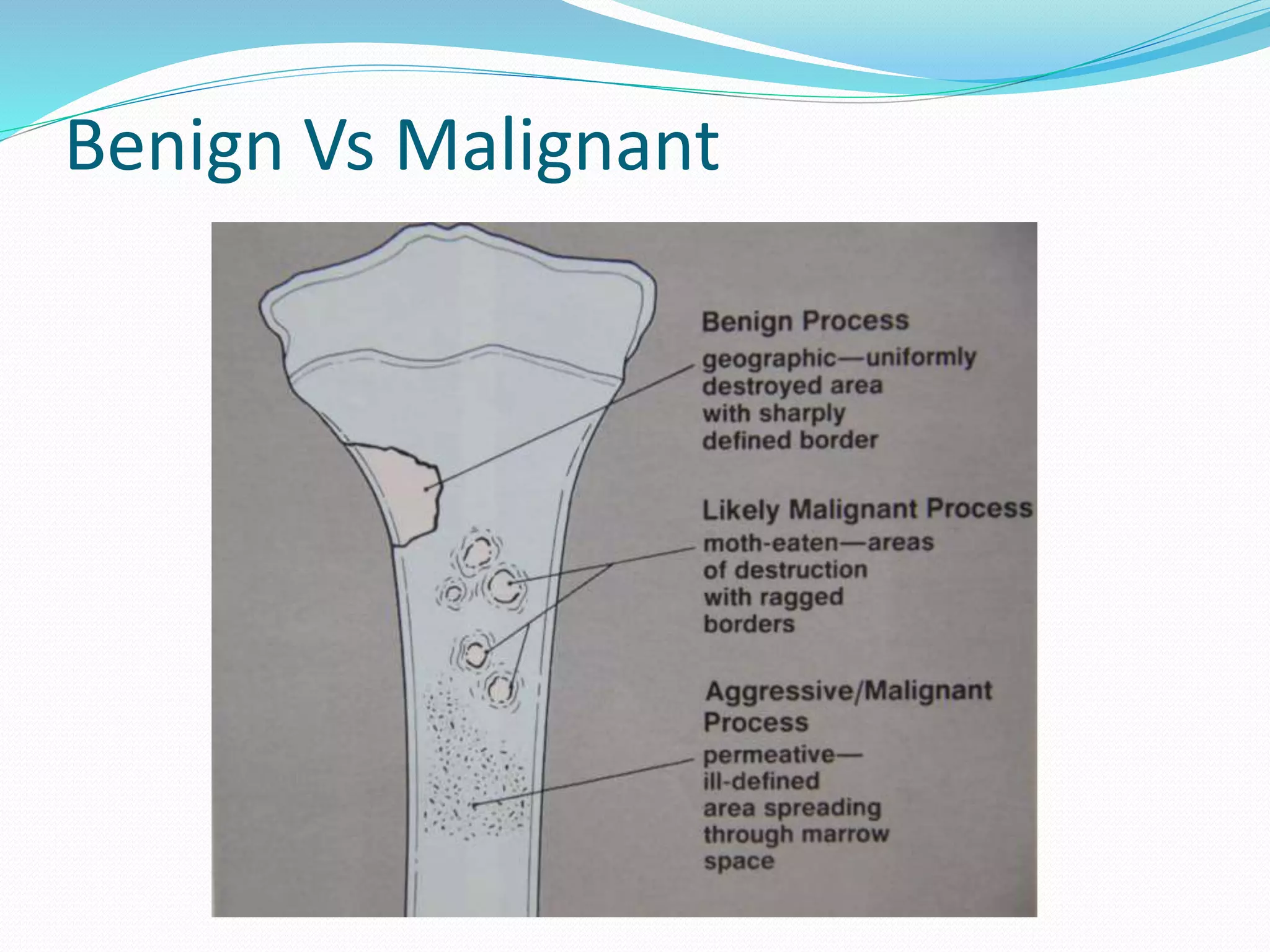 Bone Pressed Approach Bone Lesion Approach.pptx