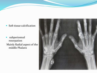  Soft tissue calcification
 subperiosteal
resorpation
Mainly Radial aspect of the
middle Phalanx
 
