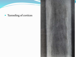  Tunneling of cortices
 