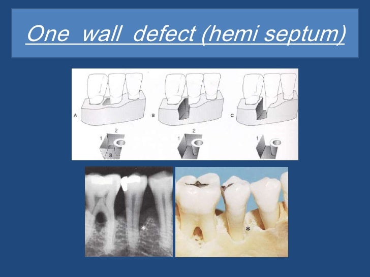 Bone Loss Bone Loss